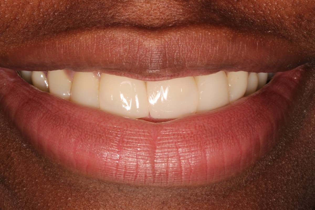 Composite Bonding — Anterior Teeth — after