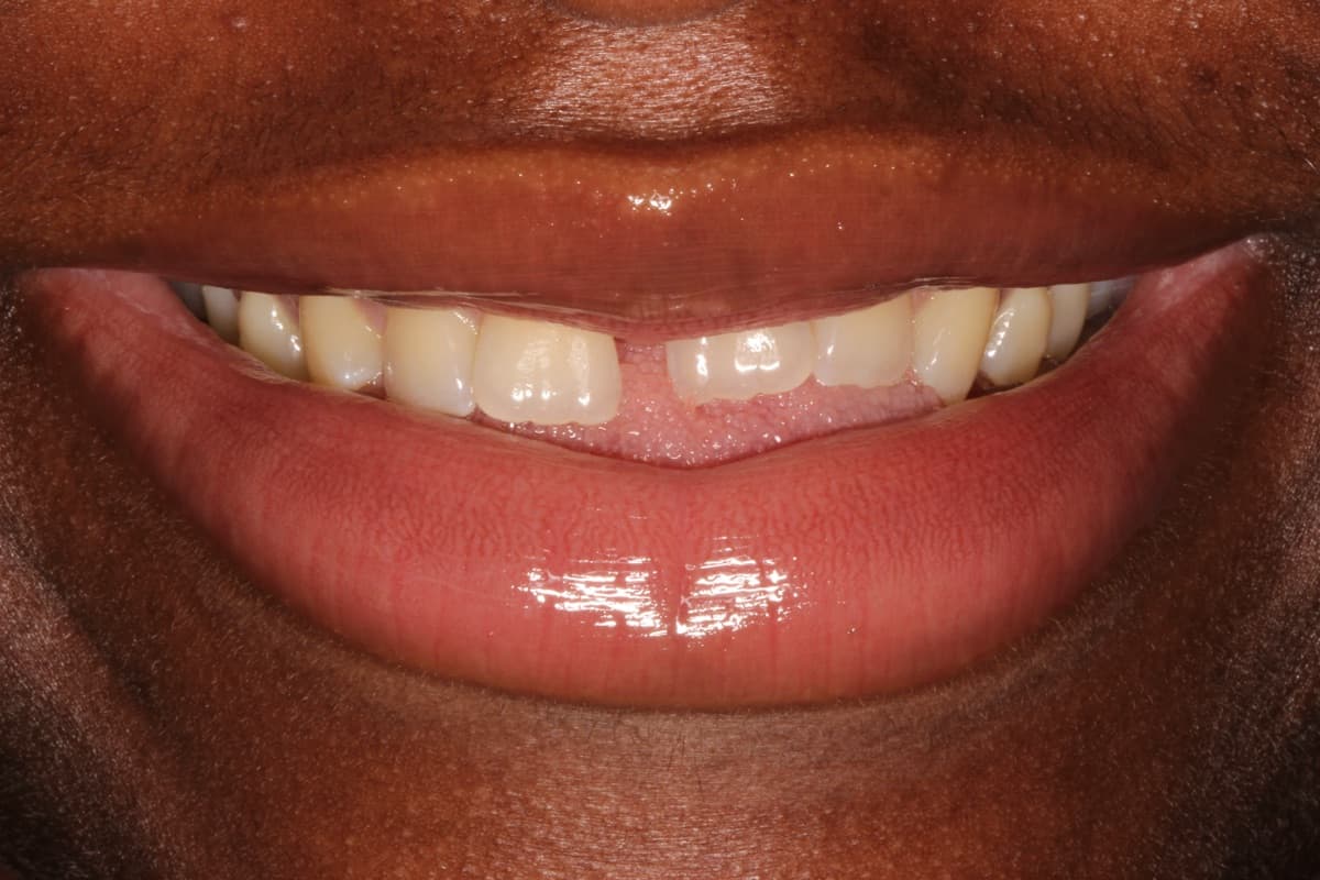 Composite Bonding — Anterior Teeth — before