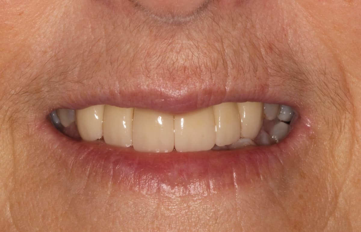 Bridge Rehabilitation — after