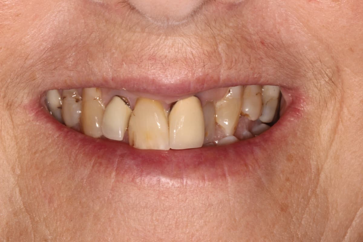 Bridge Rehabilitation — before