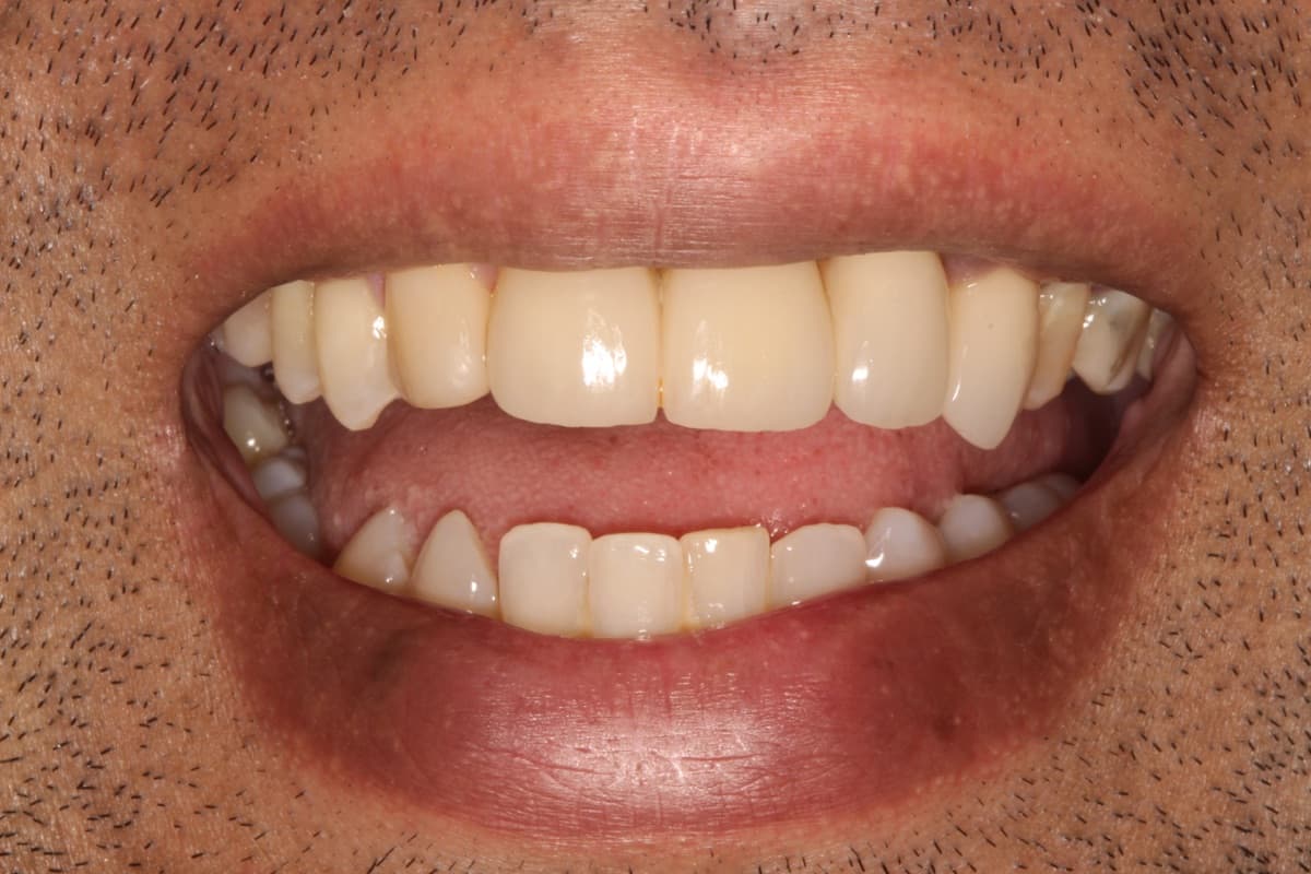 Smile Makeover — Bridge Work — after