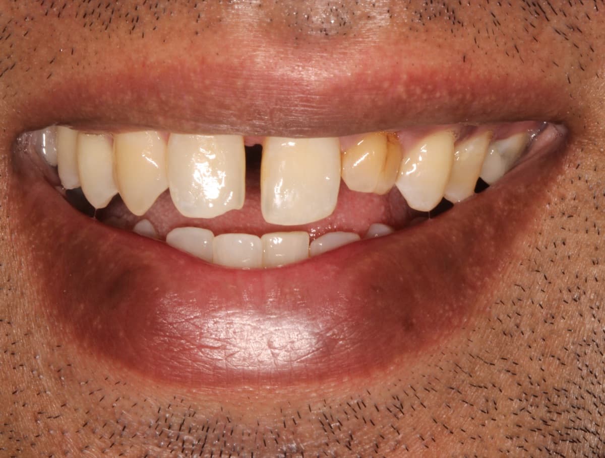 Smile Makeover — Bridge Work — before