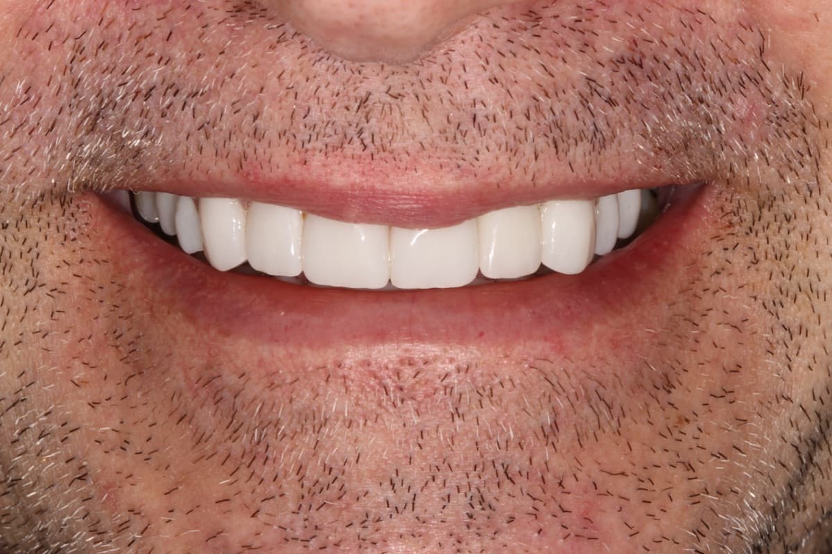 Full Mouth Rehabilitation — Crowns — after