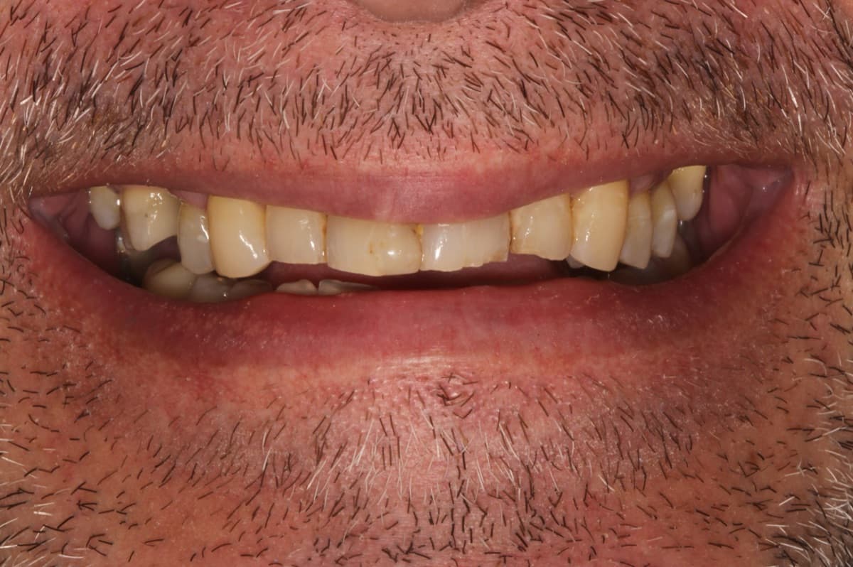 Full Mouth Rehabilitation — Crowns — before