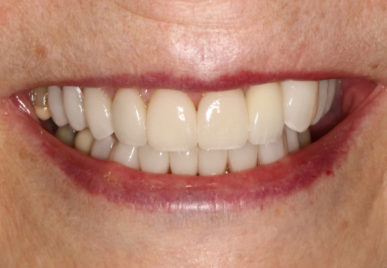 Full Mouth Rehabilitation — after