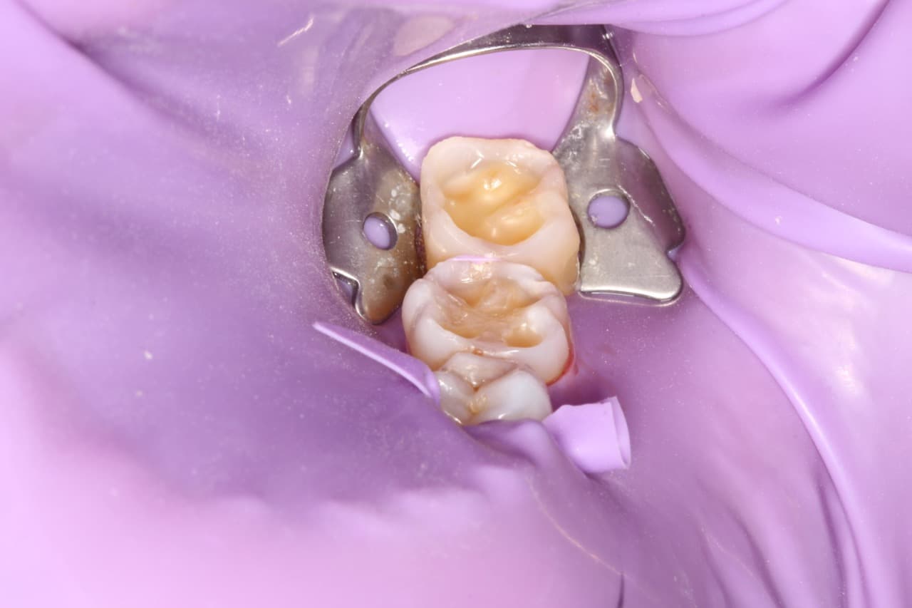 Precision Fillings Under Rubber Dam — before