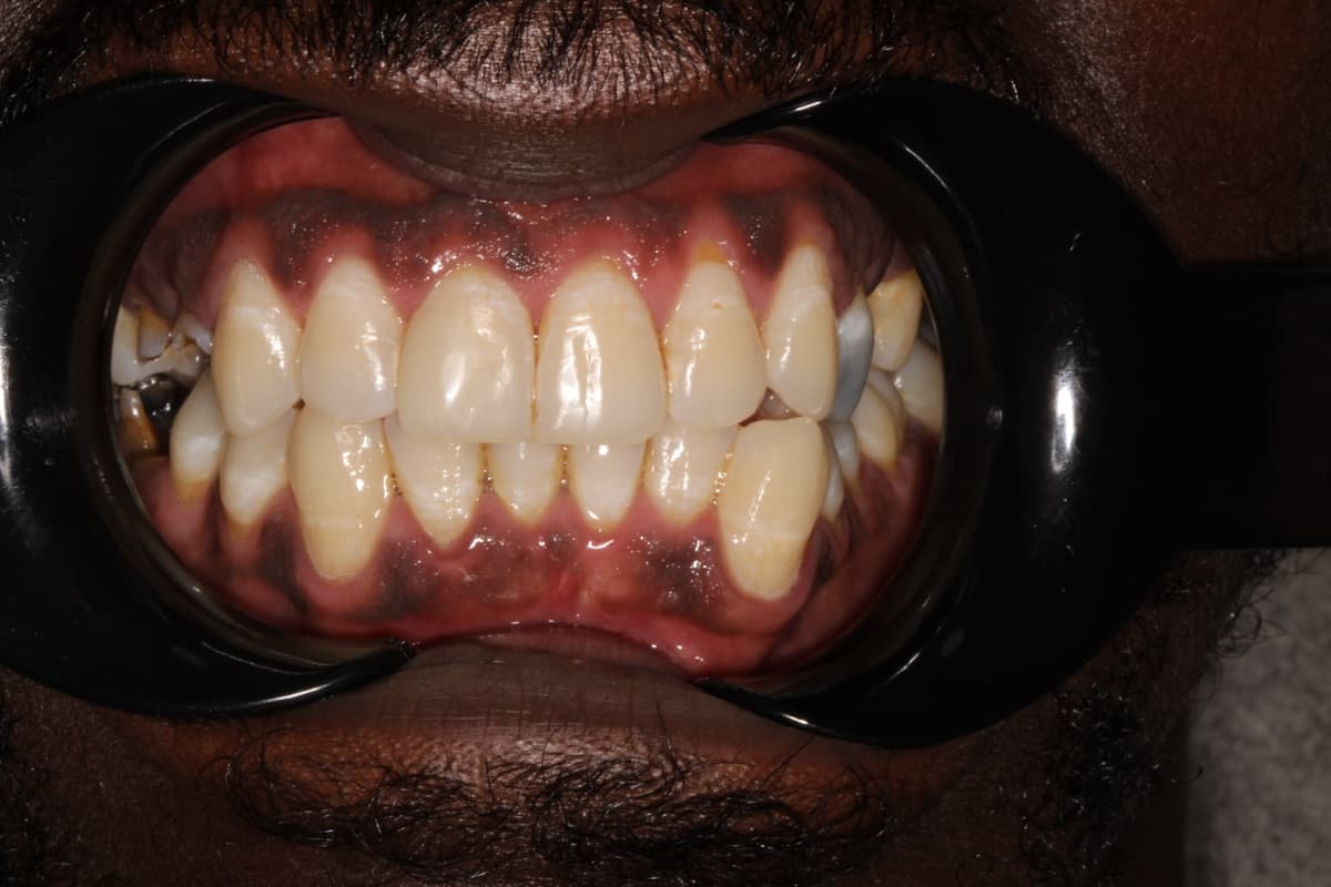Single Tooth Composite Bonding — after