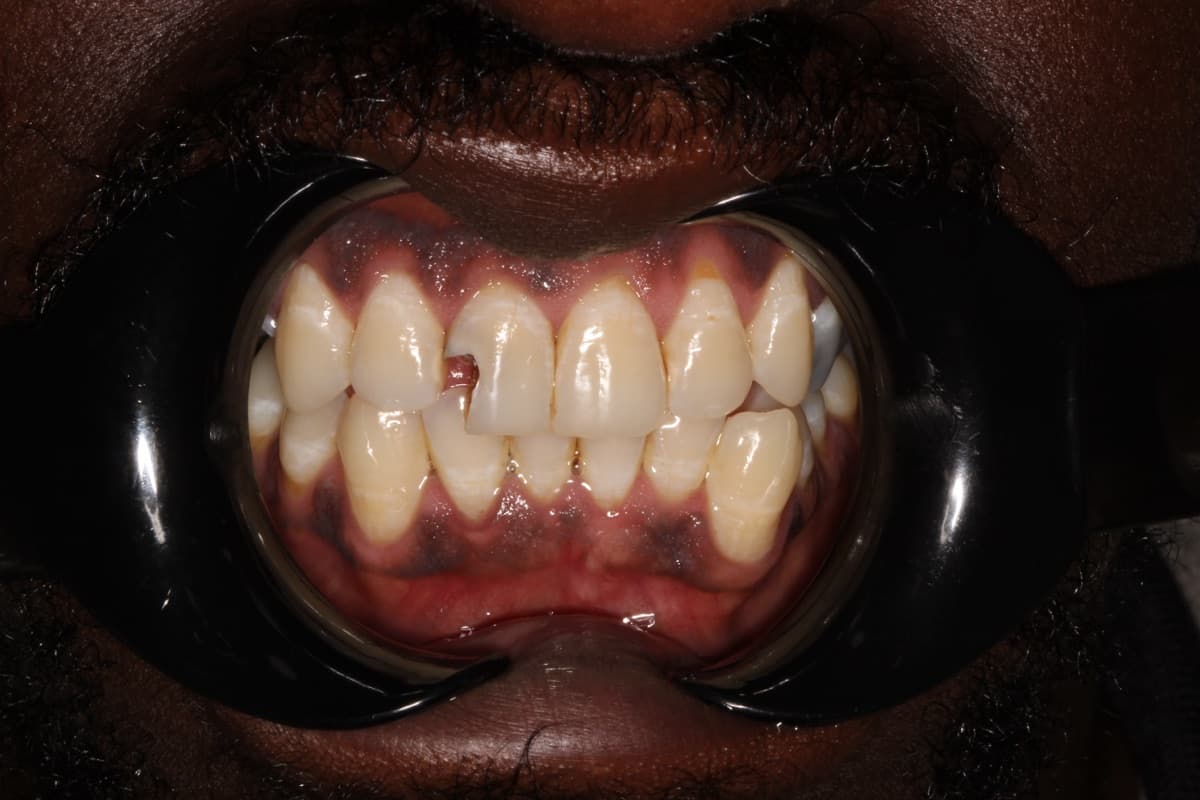 Single Tooth Composite Bonding — before